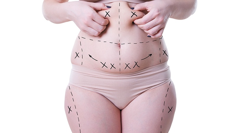 Benefits of a tummy tuck surgery - My Imperial Care